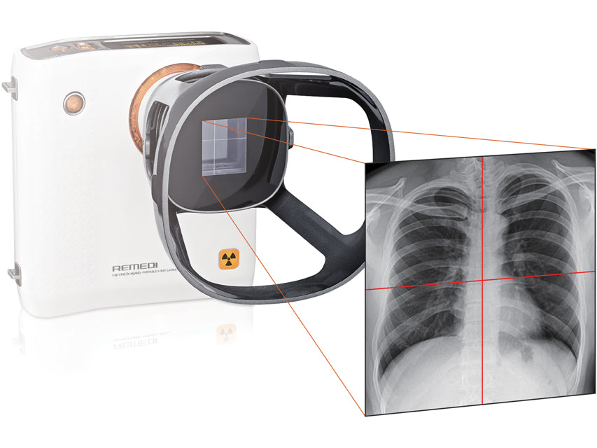Camera a raggi-X portatile Remex KA6 con collimatore - vista 2