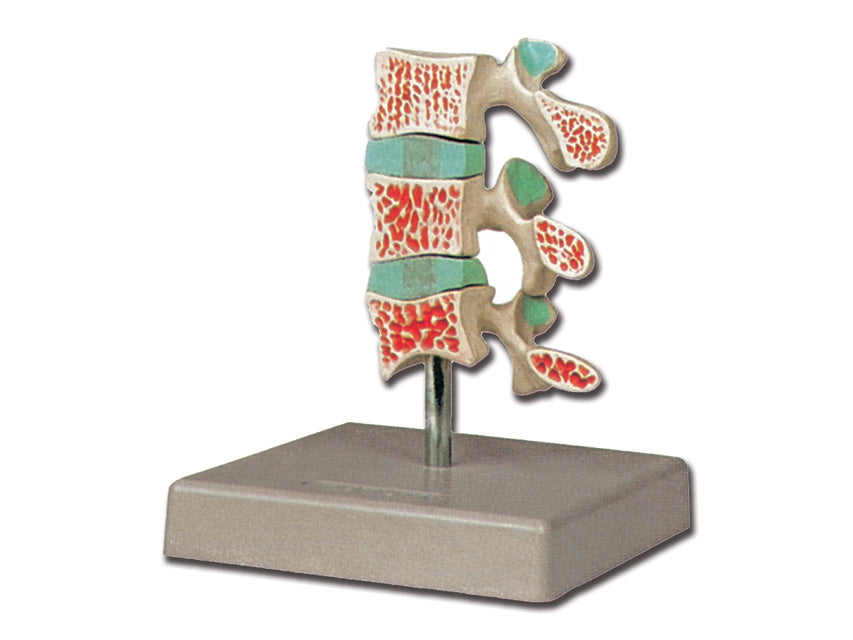 Modello Osteoporosi